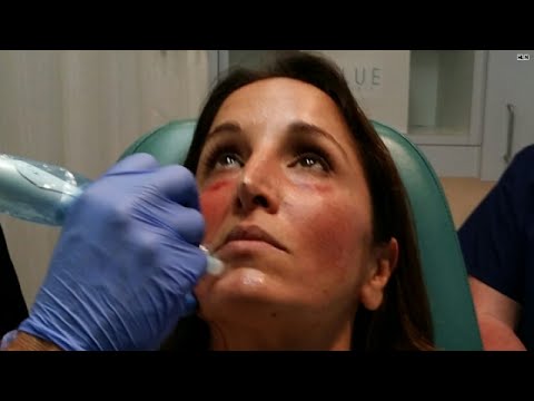 Video: That time Yasmin got a Vampire Facial