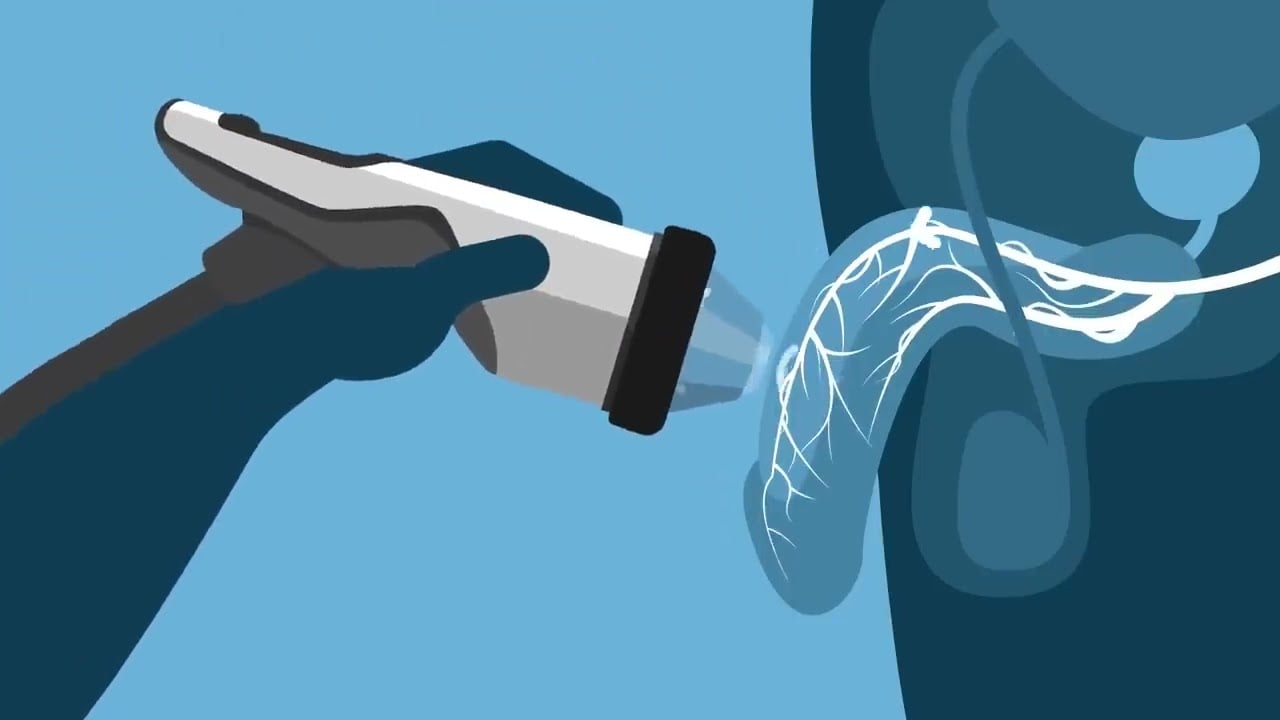 storz medical video on shockwaves for ED