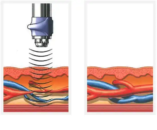 eswt blood flow before after