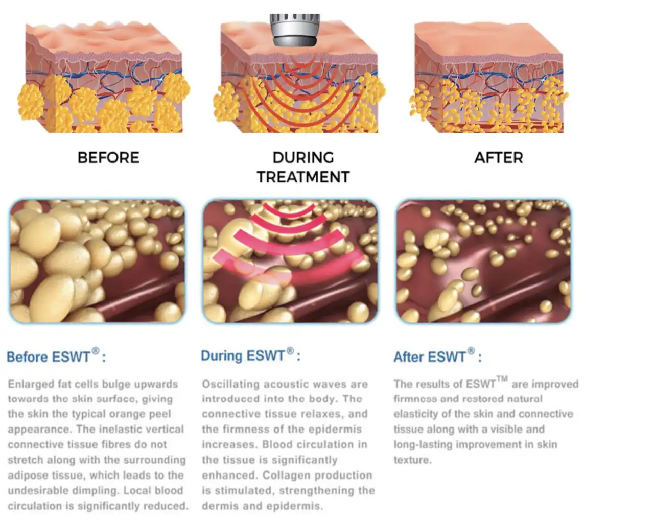 acoustic sound wave therapy