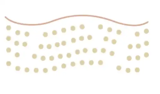 1 Skin dermis loses collagen