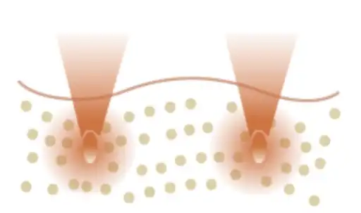 2 Ultrasound energy causes micro injury