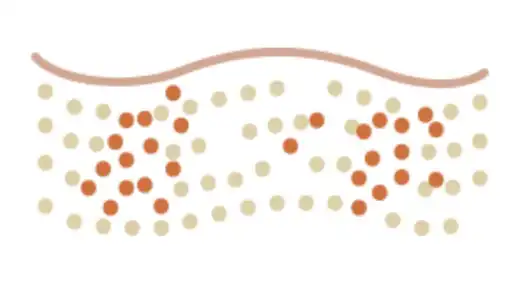 3 Inflammation triggers new collagen