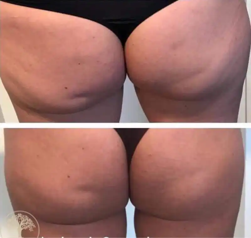 8 Slim Pod Treatments