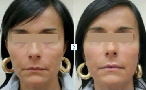 Before & Immediately After 1 ChillTite
