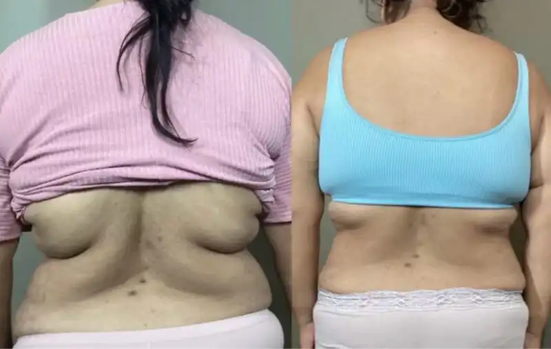 Incredible Waist and Back Fat Trimmed