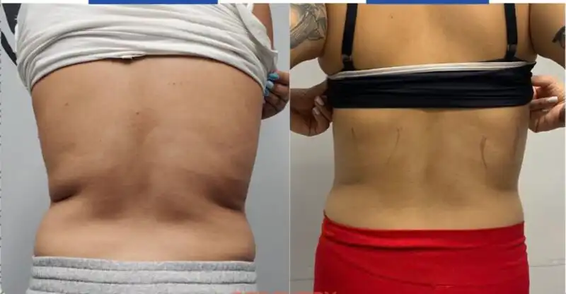 Works on Love Handles!