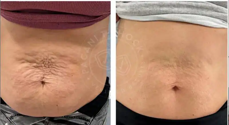 Works for Skin Tightening!