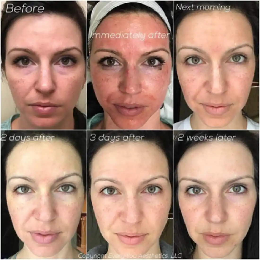 Vampire Facial